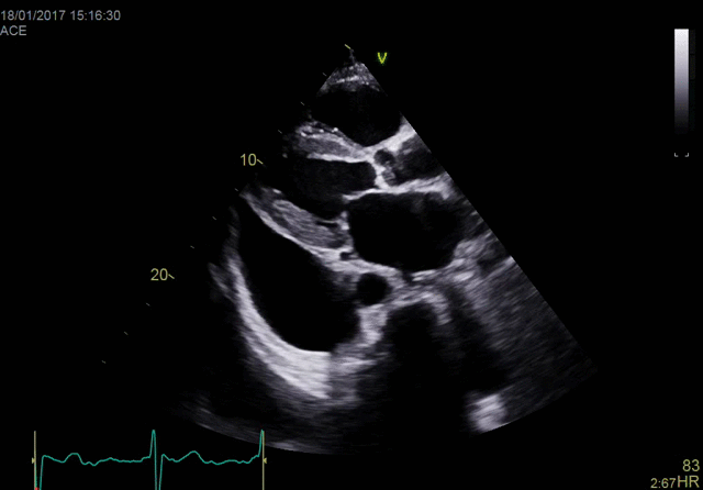 Функция True Confocal Imaging (TCI) - конфокальная визуализация